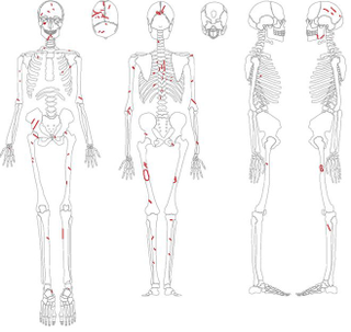Red marks indicate distribution of injuries.